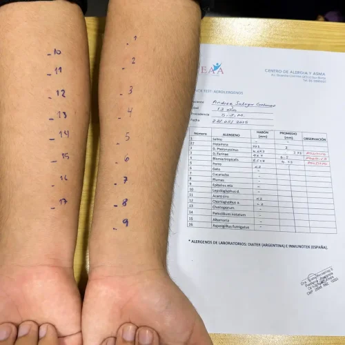 Resultados prueba cutánea